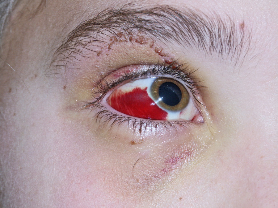 49+ Einblutung im auge bilder , Notfall „Rotes Auge“ Was kann der Hausarzt tun?