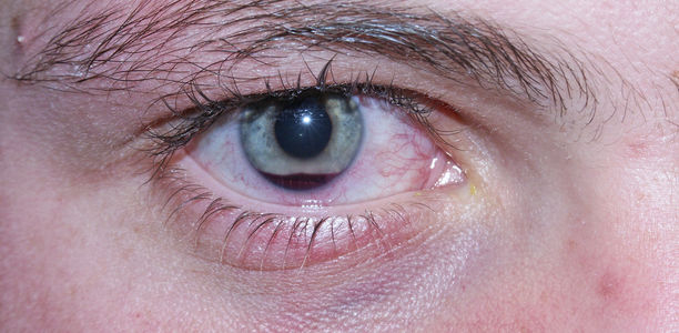 Bild zu Notfall „Rotes Auge“ - Was kann der Hausarzt tun?